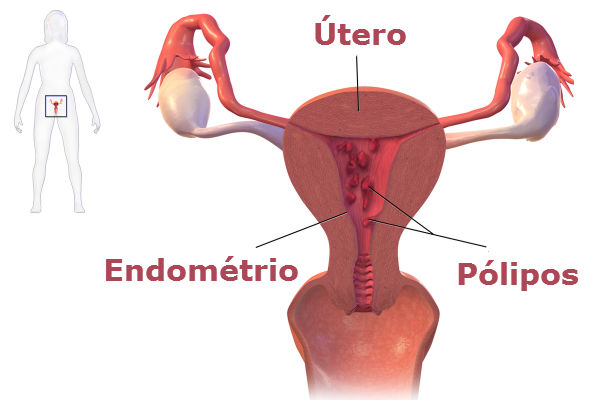 Pólipo Uterino: 5 claves ¡No se exponga!