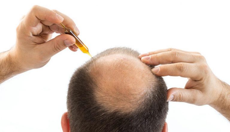 Tratamiento para la Alopecia