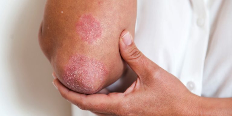 Tratamiento para la Psoriasis