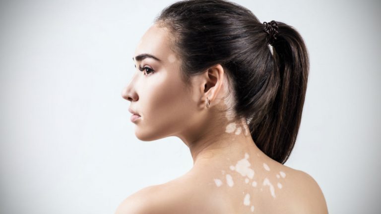 https://medicalpharmanews.com/wp-content/uploads/2019/04/el-vitiligo-puede-tratarse-eficazmente-9652-768x432.jpg