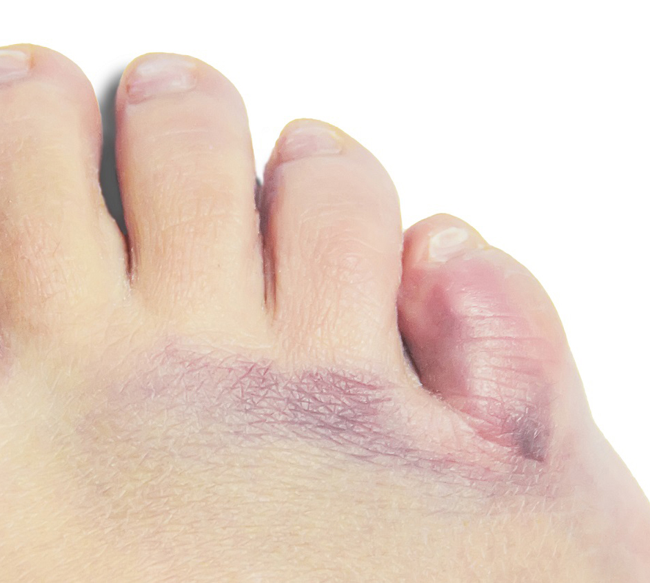 Fractura Dedo Meñique: 1 tratamiento. Medical Pharma News